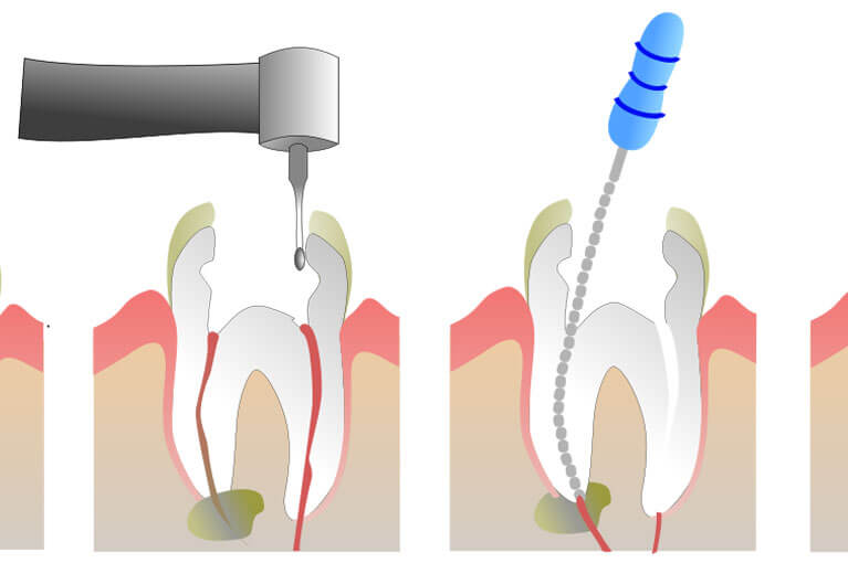 Endodoncias indoloras