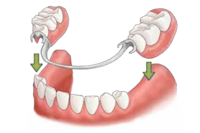Prótesis dental